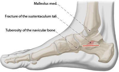 Sustentaculum Tali